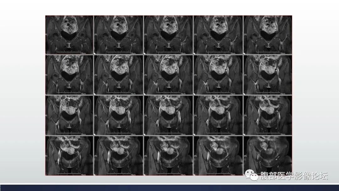 【病例】子宫内膜透明细胞癌1例MR-28