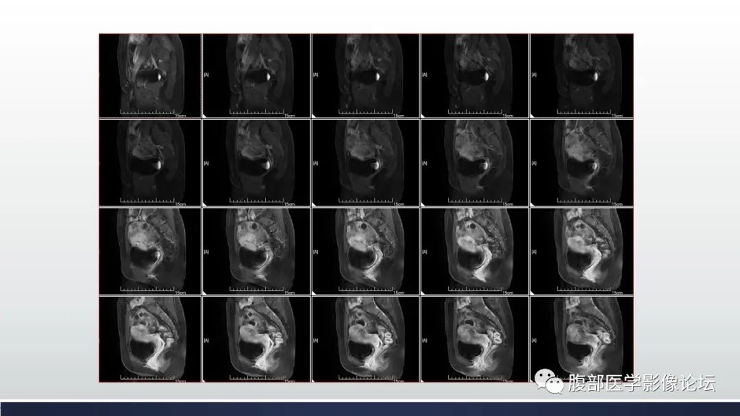 【病例】子宫内膜透明细胞癌1例MR-29
