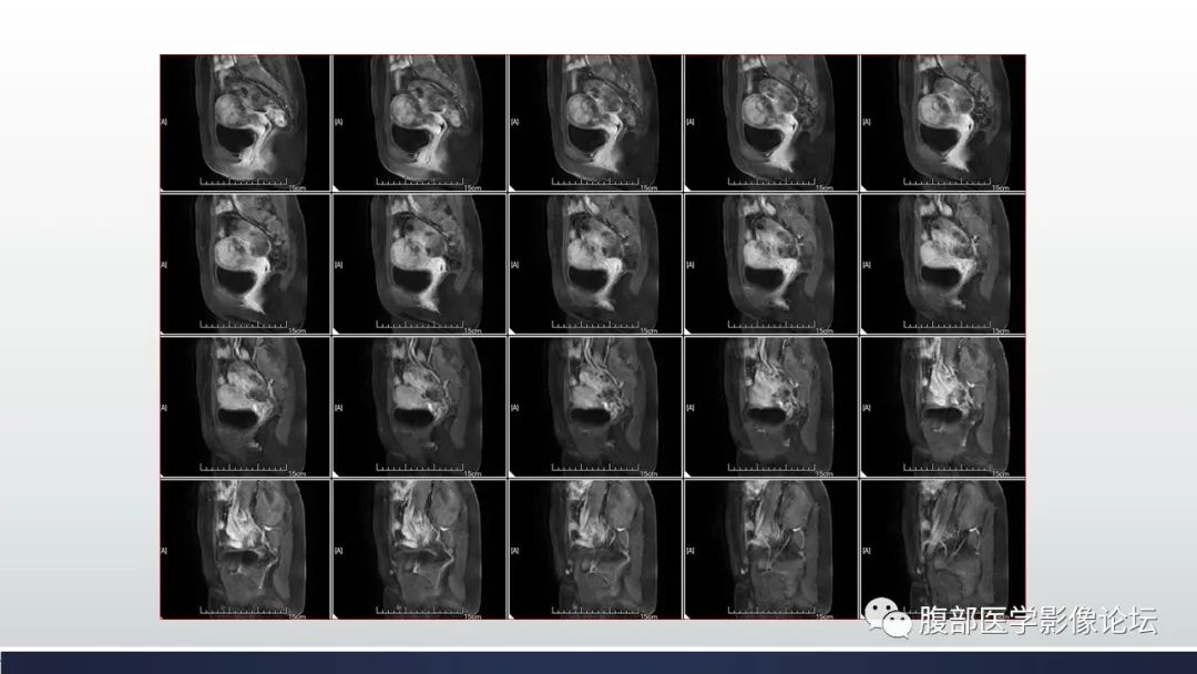 【病例】子宫内膜透明细胞癌1例MR-30