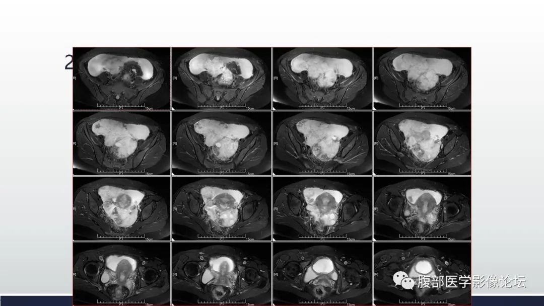 【病例】子宫内膜透明细胞癌1例MR-31