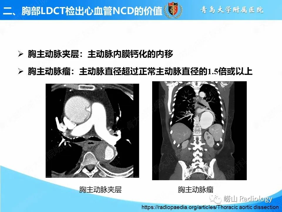 【PPT】胸部低剂量CT肺癌筛查在检出其他常见慢性非传染性疾病的价值-6