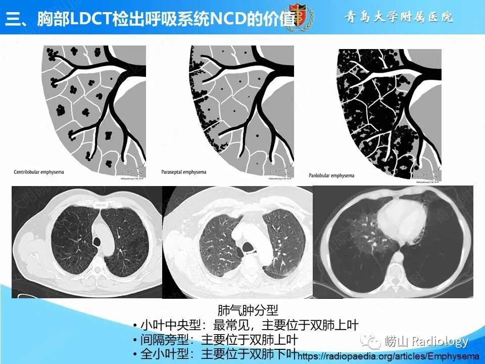 【PPT】胸部低剂量CT肺癌筛查在检出其他常见慢性非传染性疾病的价值-8