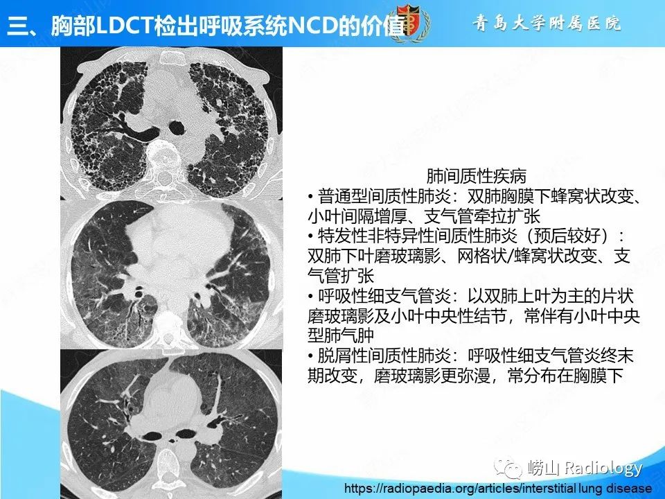 【PPT】胸部低剂量CT肺癌筛查在检出其他常见慢性非传染性疾病的价值-10