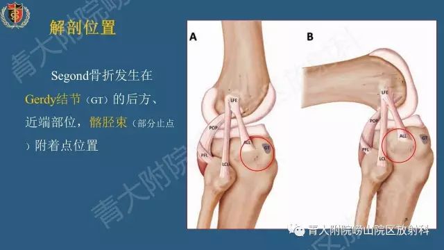 【PPT】Segond骨折-3