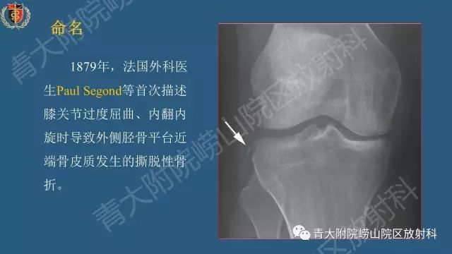 【PPT】Segond骨折-2
