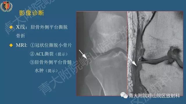 【PPT】Segond骨折-5