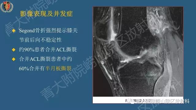【PPT】Segond骨折-4
