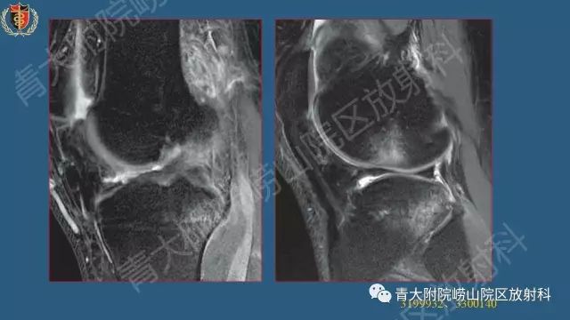 【PPT】Segond骨折-6