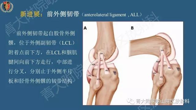 【PPT】Segond骨折-1