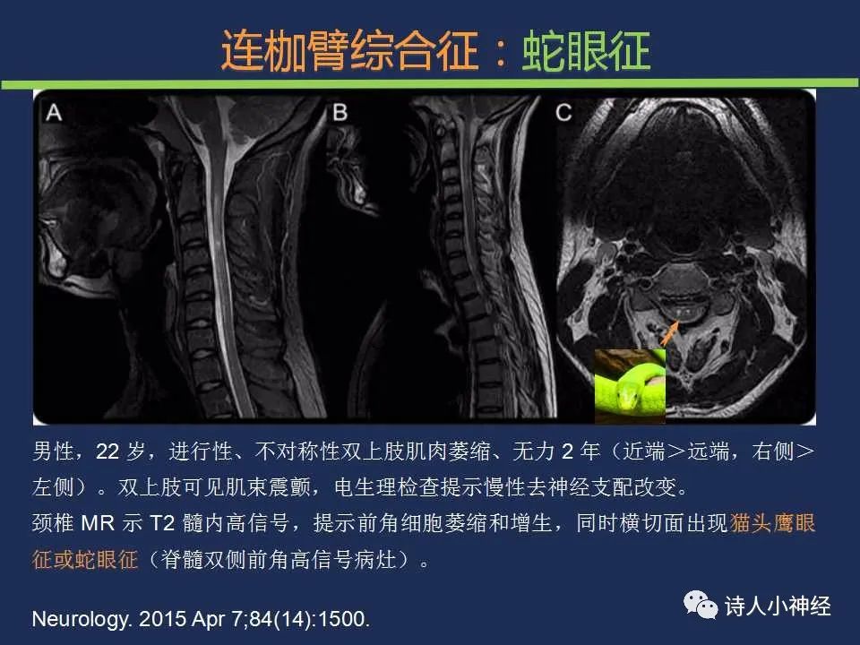【PPT】“蛇眼征”影像汇总-7