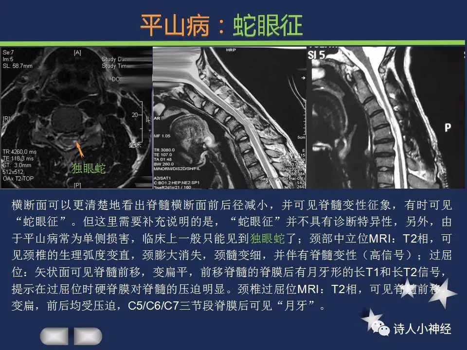 【PPT】“蛇眼征”影像汇总-6