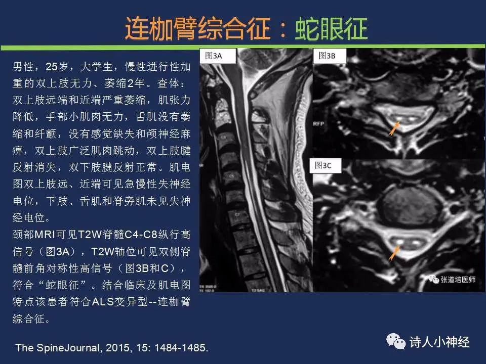 【PPT】“蛇眼征”影像汇总-9