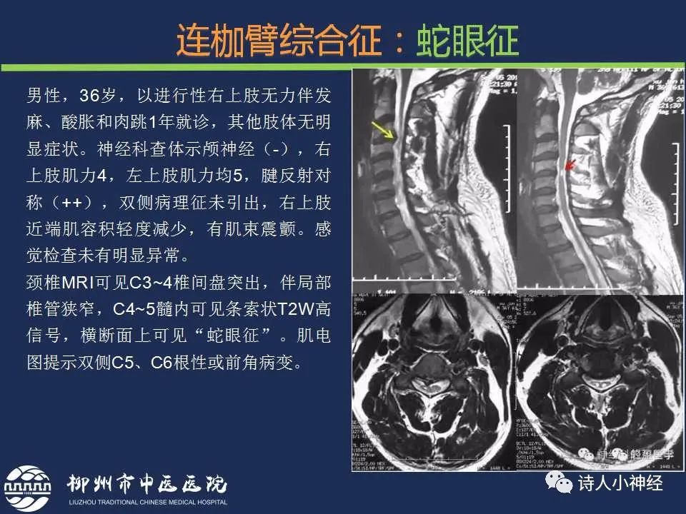 【PPT】“蛇眼征”影像汇总-10