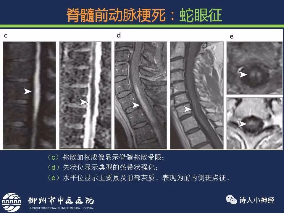【PPT】“蛇眼征”影像汇总-12