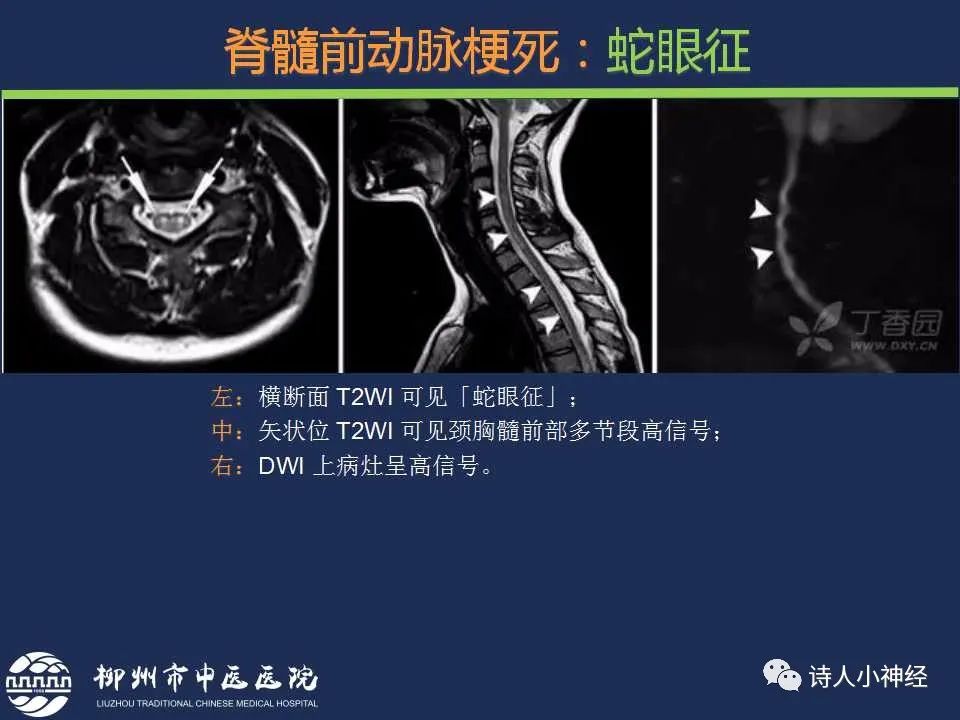 【PPT】“蛇眼征”影像汇总-13