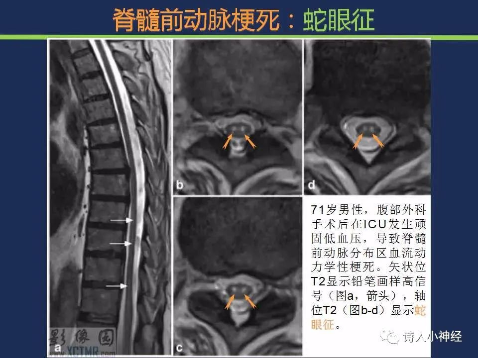 【PPT】“蛇眼征”影像汇总-14