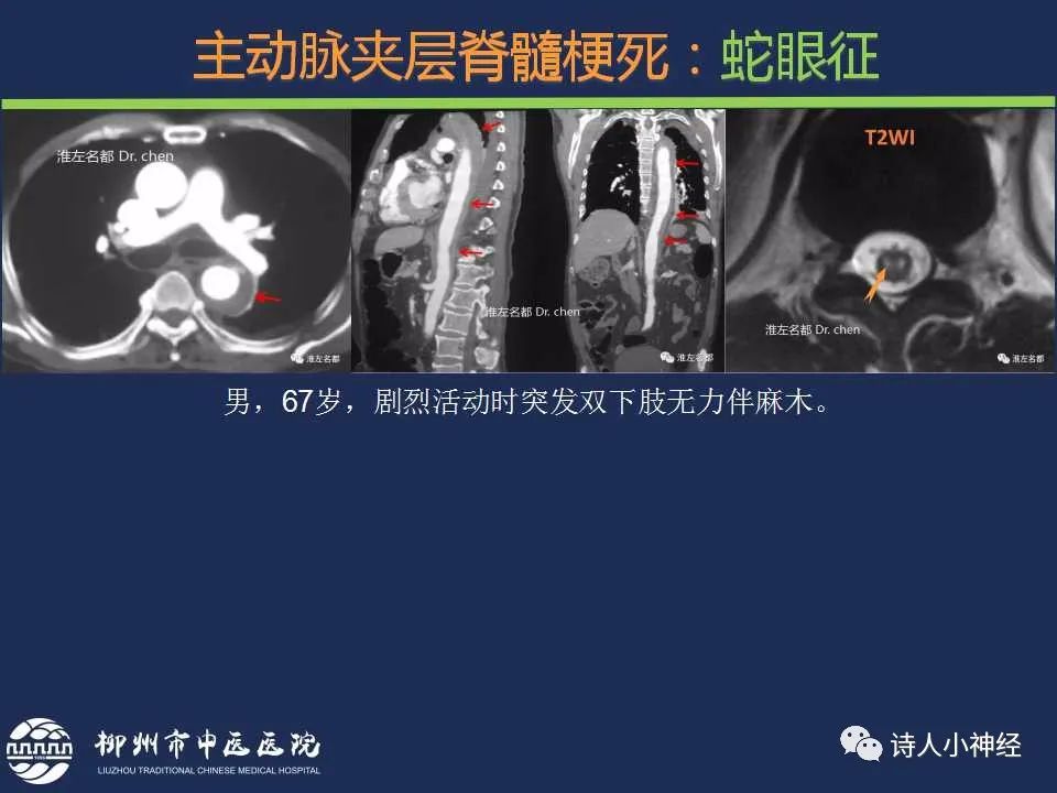 【PPT】“蛇眼征”影像汇总-18