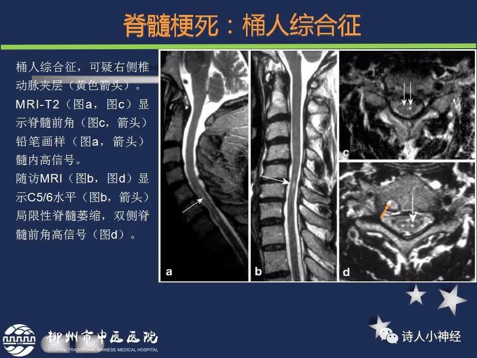 【PPT】“蛇眼征”影像汇总-19