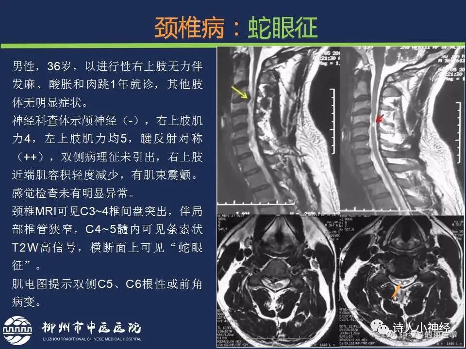 【PPT】“蛇眼征”影像汇总-20