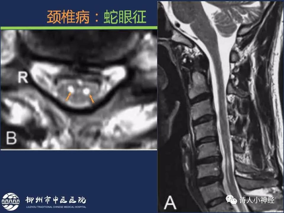 【PPT】“蛇眼征”影像汇总-21