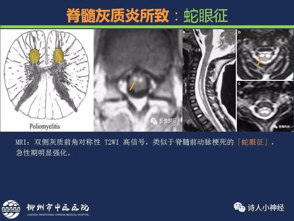 【PPT】“蛇眼征”影像汇总-23