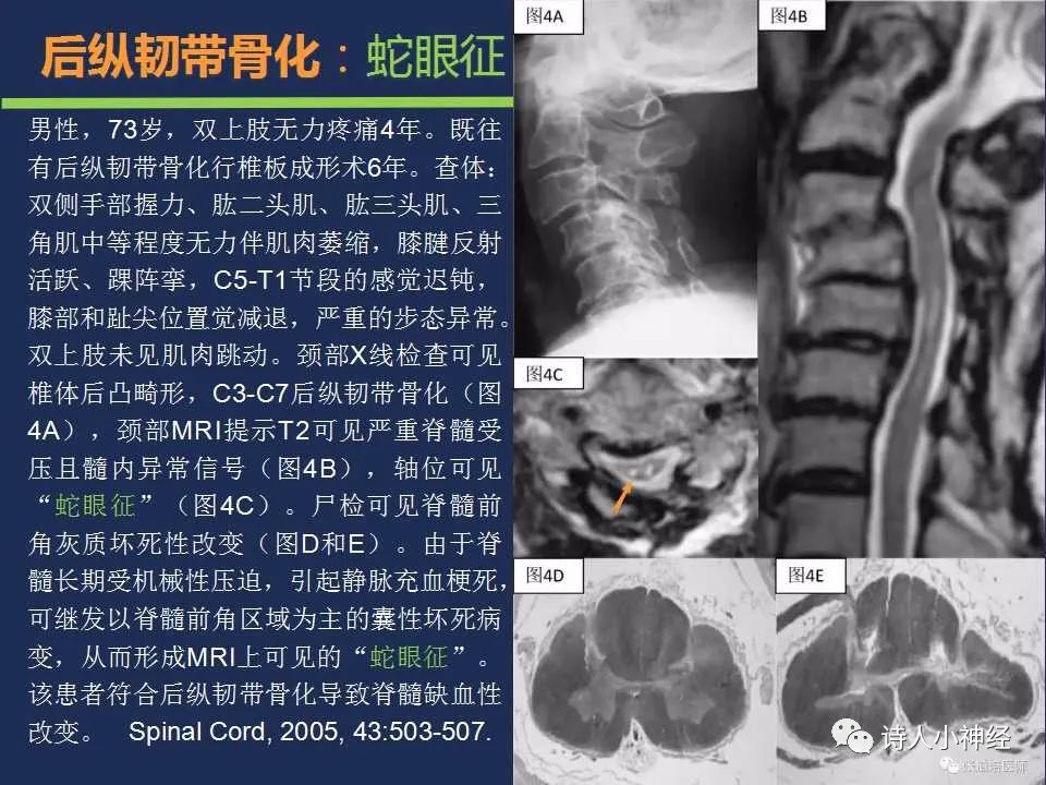【PPT】“蛇眼征”影像汇总-24