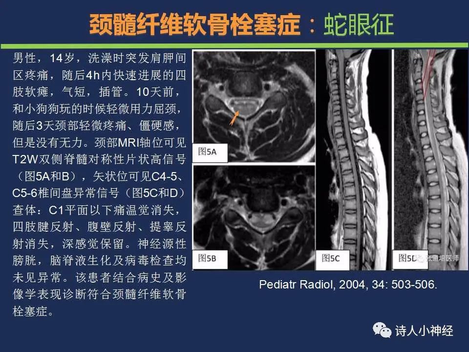 【PPT】“蛇眼征”影像汇总-25