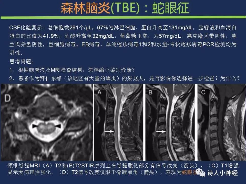 【PPT】“蛇眼征”影像汇总-27