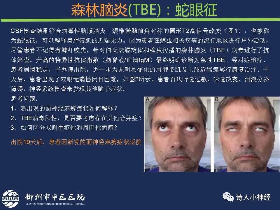 【PPT】“蛇眼征”影像汇总-28