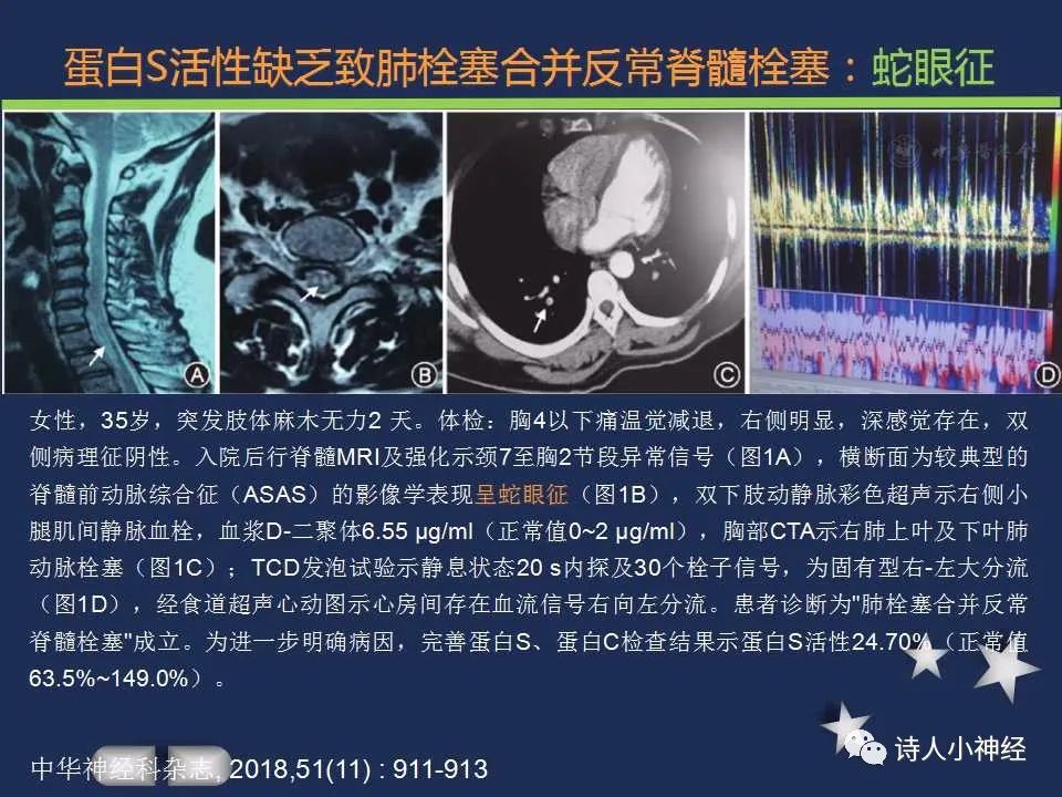 【PPT】“蛇眼征”影像汇总-31