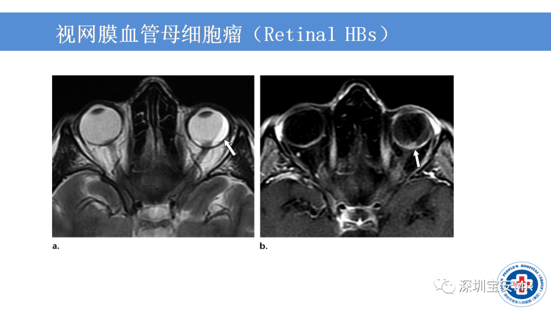 【PPT】VHL综合症及相关肿瘤-11