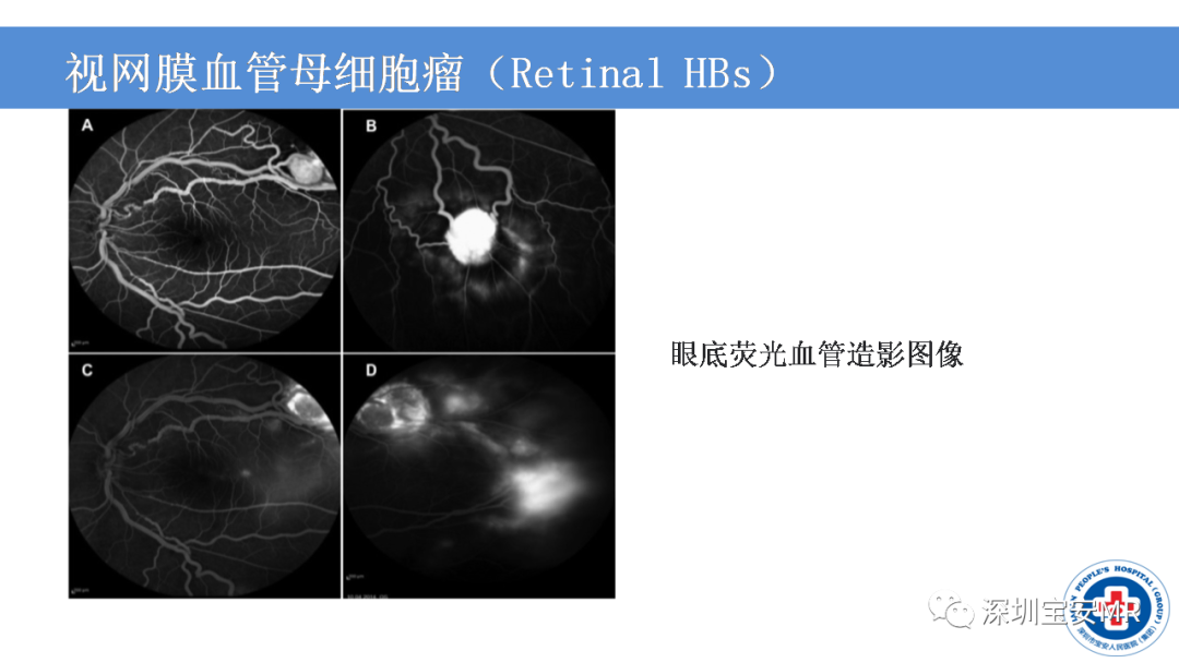【PPT】VHL综合症及相关肿瘤-12