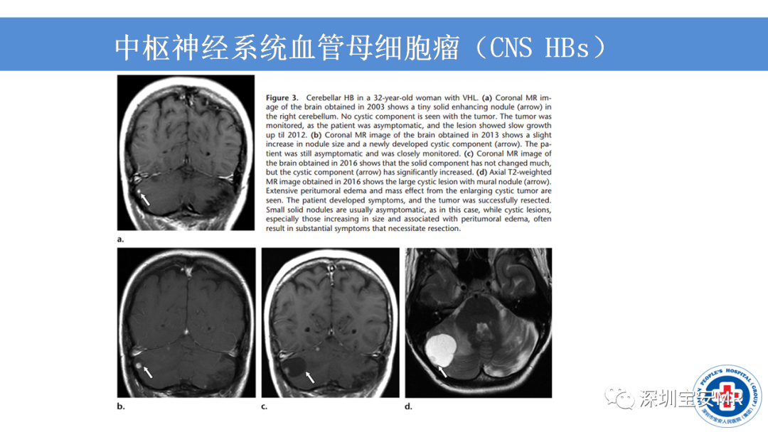 【PPT】VHL综合症及相关肿瘤-15