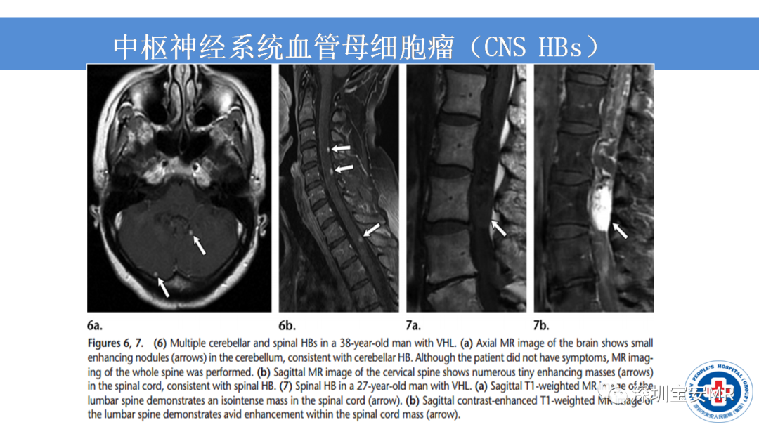 【PPT】VHL综合症及相关肿瘤-17