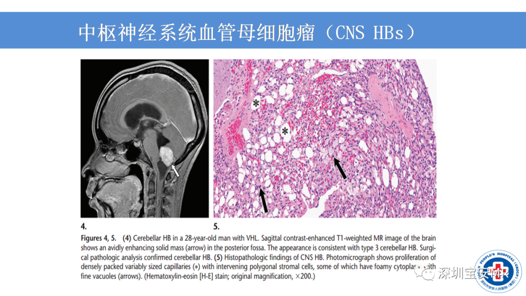 【PPT】VHL综合症及相关肿瘤-16