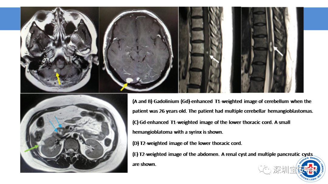 【PPT】VHL综合症及相关肿瘤-18