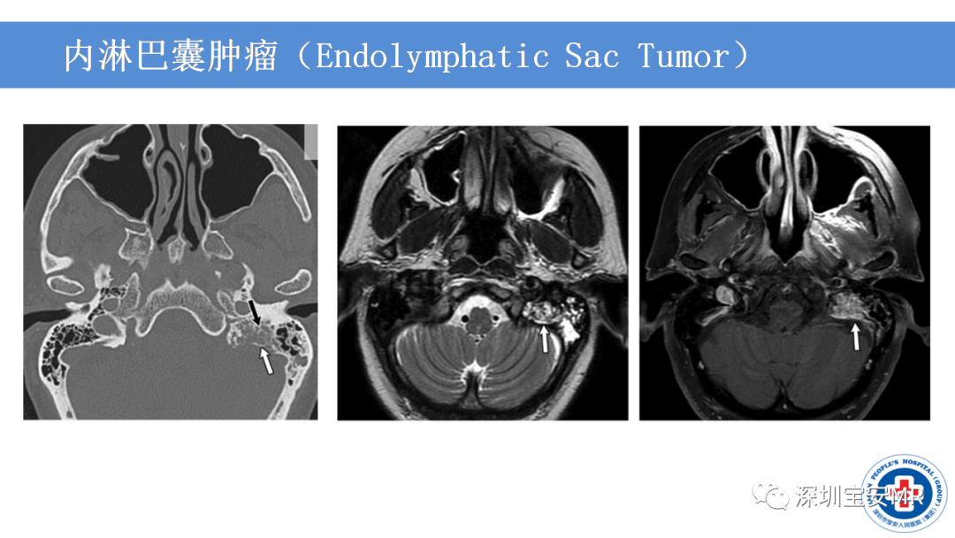 【PPT】VHL综合症及相关肿瘤-21