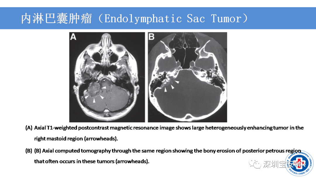 【PPT】VHL综合症及相关肿瘤-22