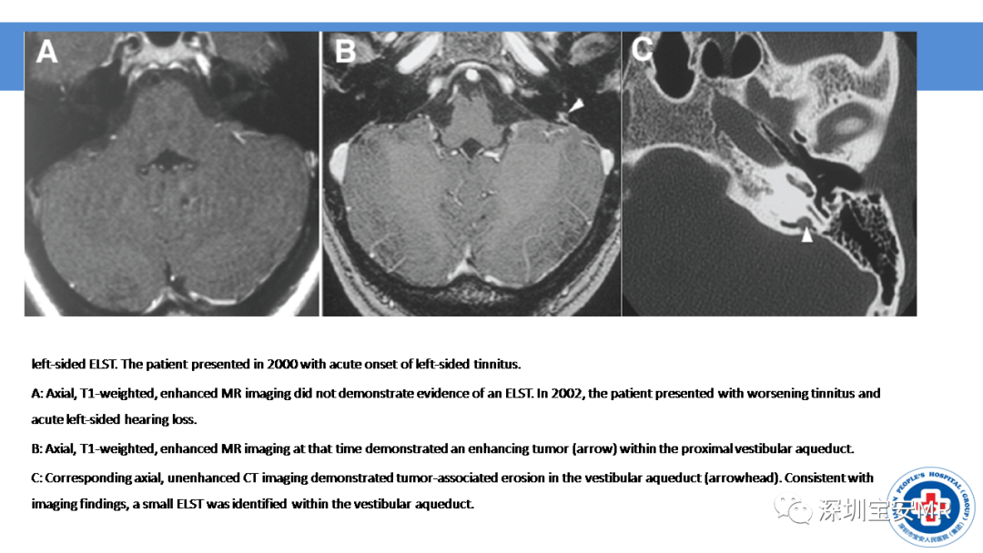 【PPT】VHL综合症及相关肿瘤-24