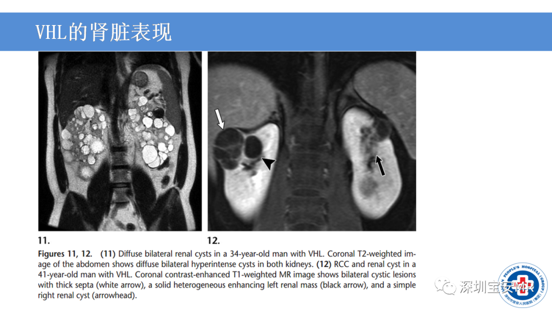 【PPT】VHL综合症及相关肿瘤-26
