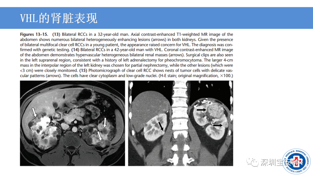 【PPT】VHL综合症及相关肿瘤-27