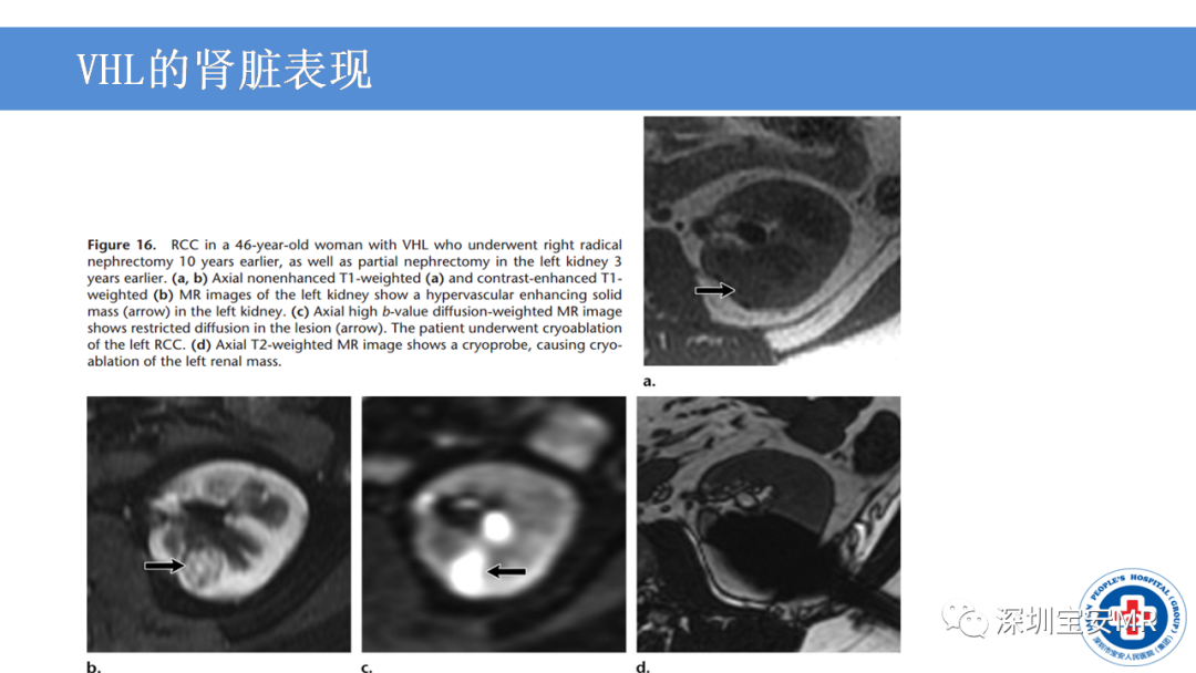 【PPT】VHL综合症及相关肿瘤-28