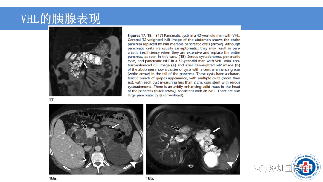 【PPT】VHL综合症及相关肿瘤-32