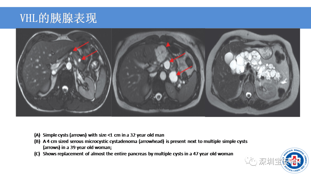 【PPT】VHL综合症及相关肿瘤-33