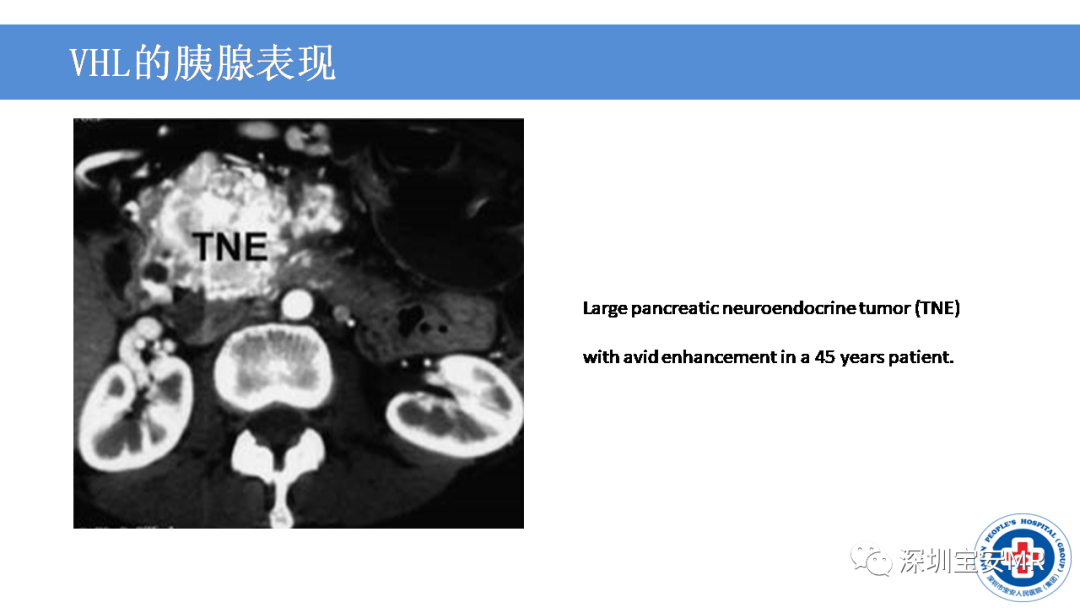 【PPT】VHL综合症及相关肿瘤-34
