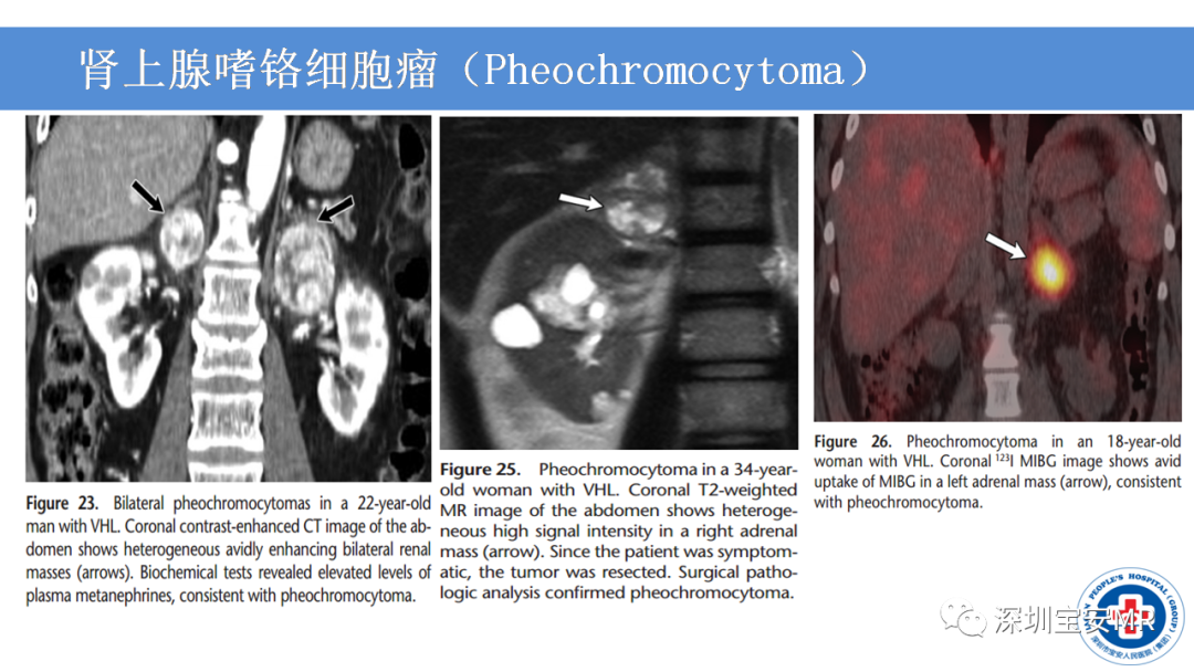 【PPT】VHL综合症及相关肿瘤-37