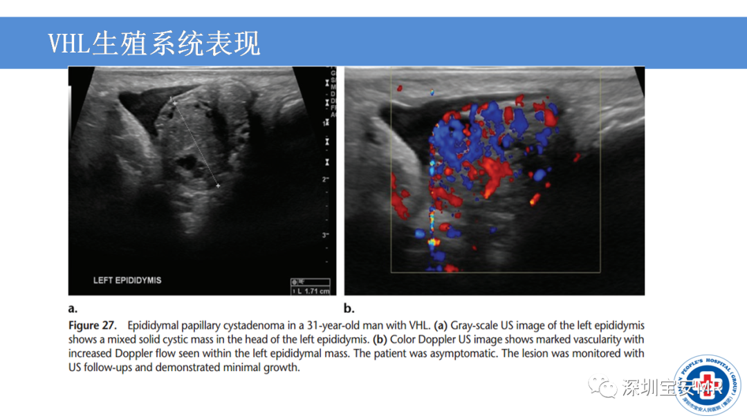 【PPT】VHL综合症及相关肿瘤-39