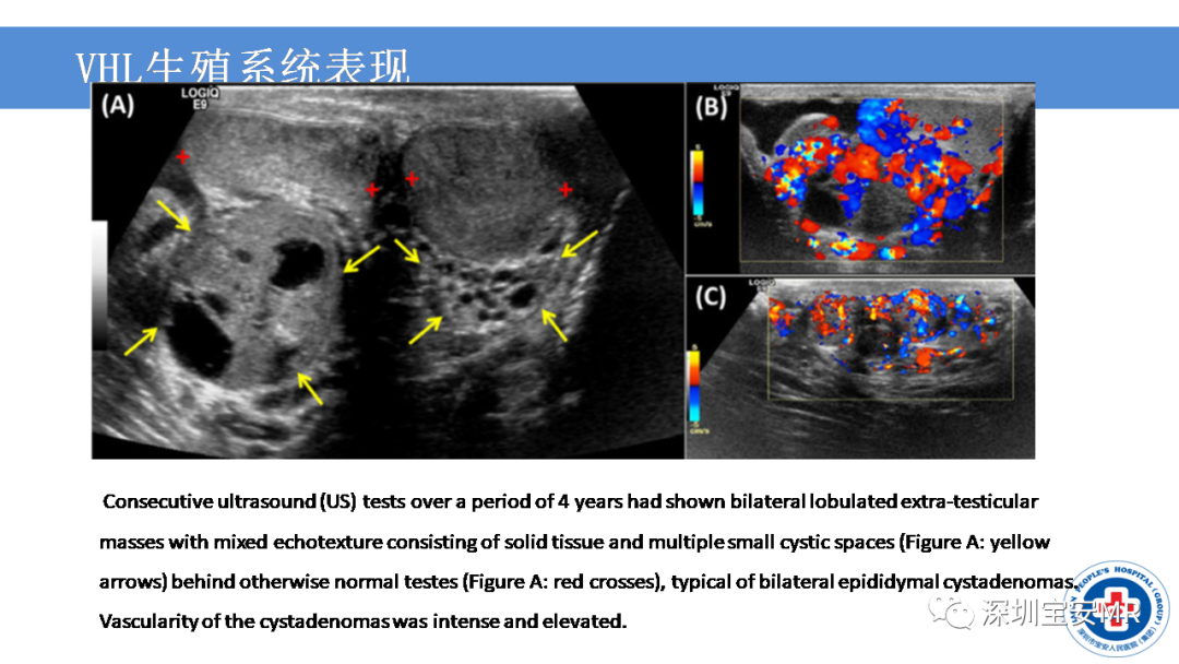【PPT】VHL综合症及相关肿瘤-40