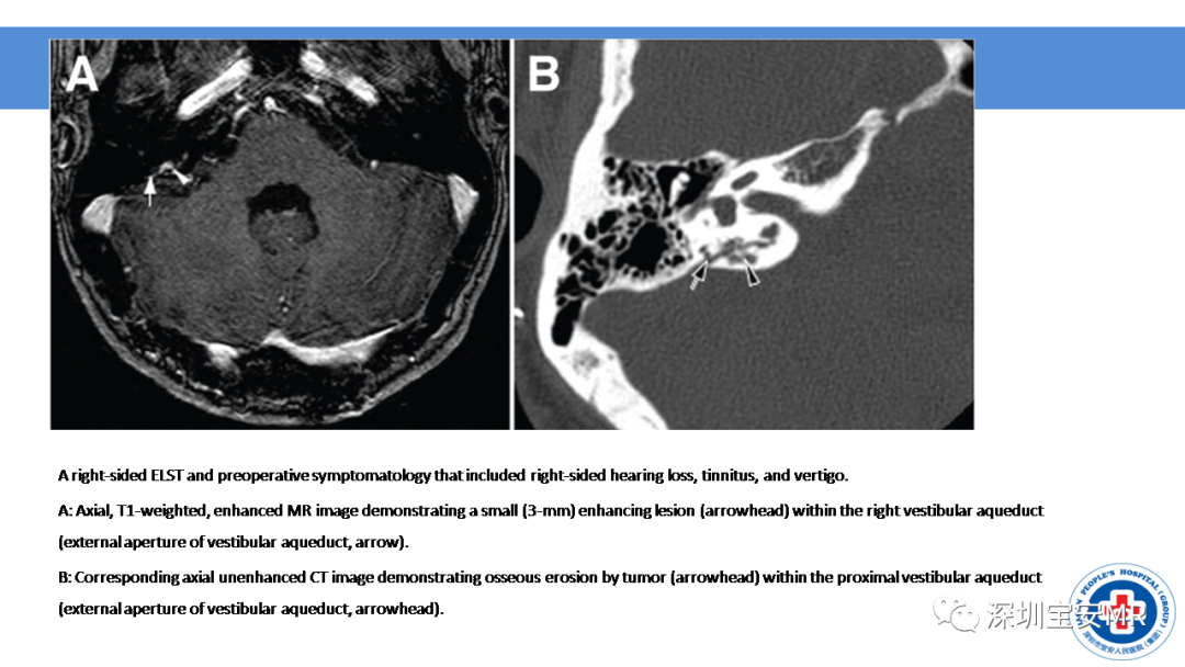 【PPT】VHL综合症及相关肿瘤-1