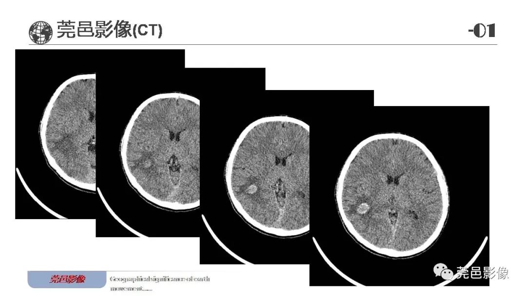 【病例】血管中心性胶质瘤一例分析-3